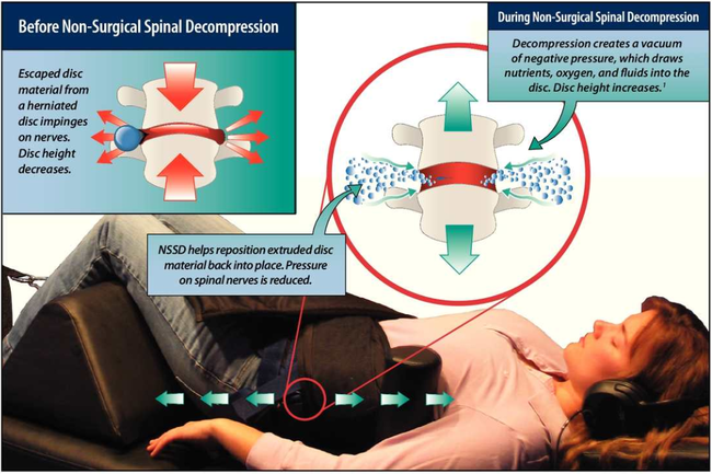 What does spinal decompression do at Apex Chiropractic Coquitlam.