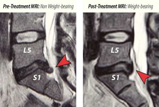 MRI before and after spinal decompression at Apex Chiropractic Coquitlam.