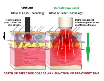 The deeper penetration with deep tissue laser therapy.