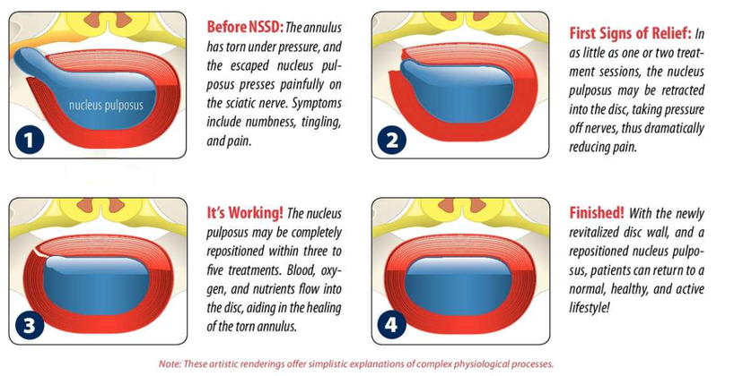 How Spinal Decompression works at Coquitlam office.